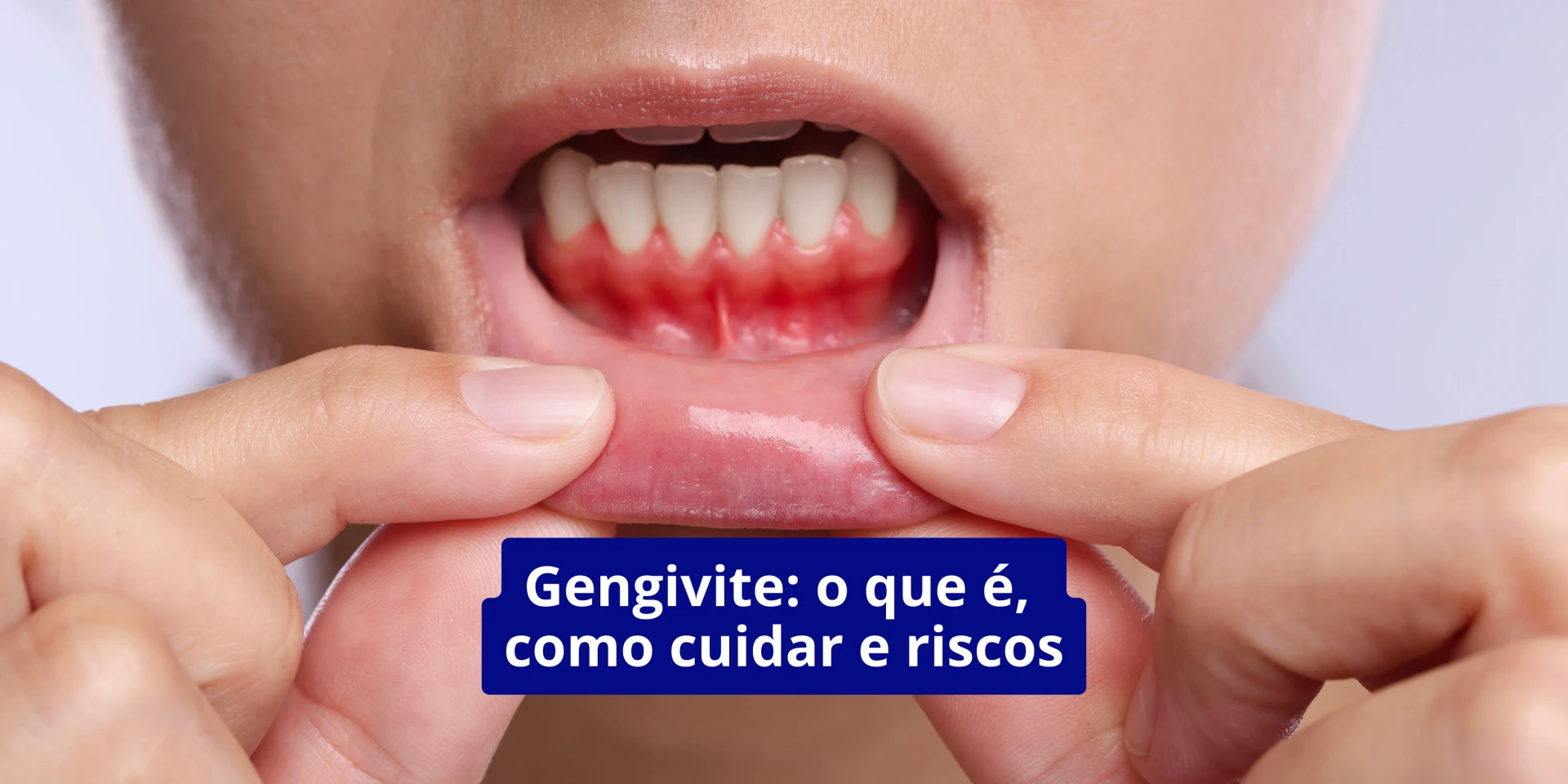 Gengivite: o que é, como cuidar ...