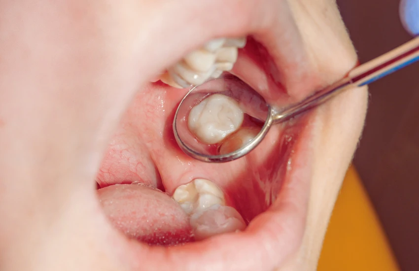 Restaurações Estéticas (Obturações)