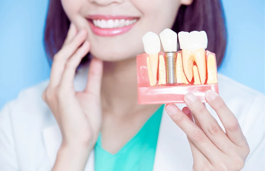 Implantes Dentários